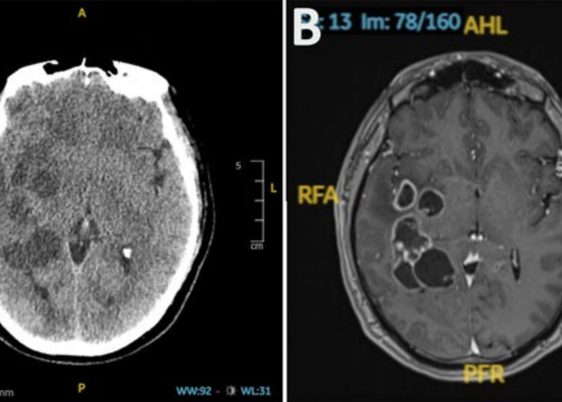 Doctors Thought a Man Had a Brain Tumor. It Turned Out His Head Was Full of Worms.