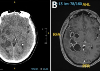 Doctors Thought a Man Had a Brain Tumor. It Turned Out His Head Was Full of Worms.