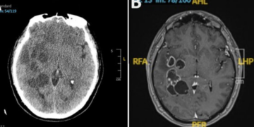 Doctors Thought a Man Had a Brain Tumor. It Turned Out His Head Was Full of Worms.