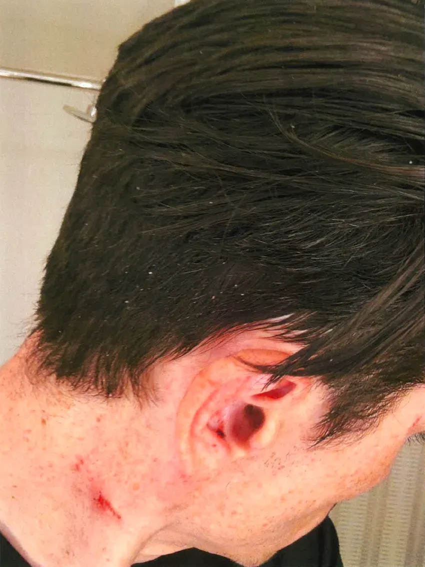 The back of a man's neck and ear, showing a scratch and red marks.