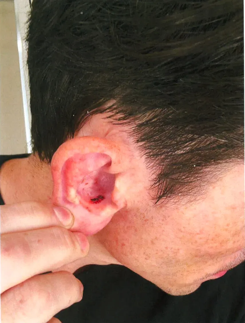 Close-up of a person's injured ear, showing a bloody wound.