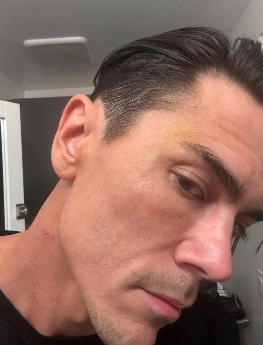 A man with a yellow bruise on his forehead and a scab on his neck.