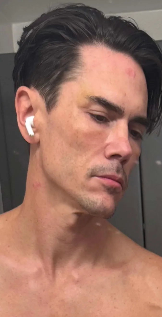 Tom Sandoval showing bruises on his face, neck, and chest.