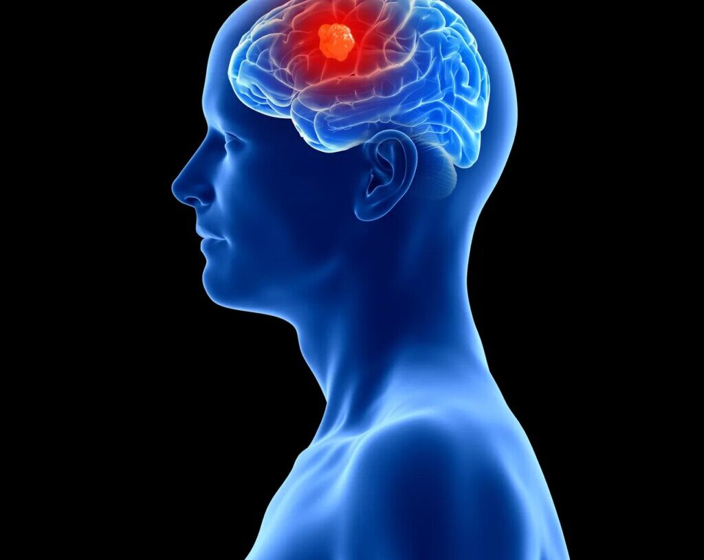 3 People Have Gotten Cancer-Detecting Implants in Their Brains