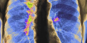 One label, many risks: how grouping Asian Americans hides deadly cancer patterns