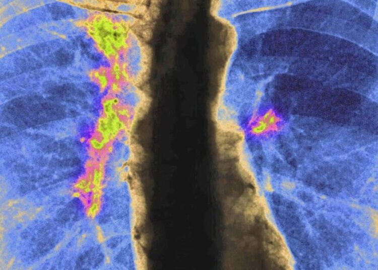 One label, many risks: how grouping Asian Americans hides deadly cancer patterns