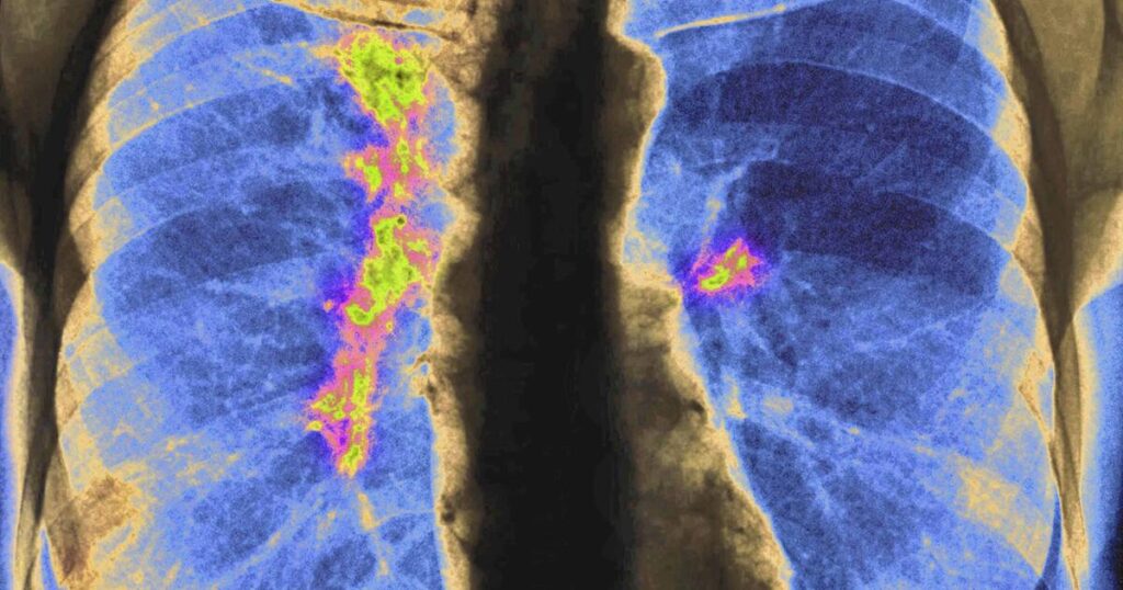 One label, many risks: how grouping Asian Americans hides deadly cancer patterns