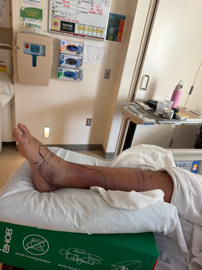 A person's leg with swelling, bruising, and medical markings, elevated on a pillow in a hospital room.