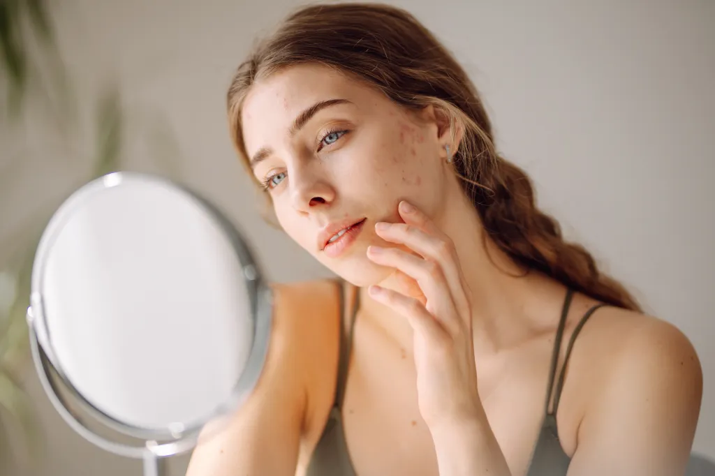 A young woman with problem skin looking into a mirror, touching her cheek.