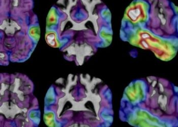 New experimental Alzheimer’s drug shows potential after study shows slower cognitive decline