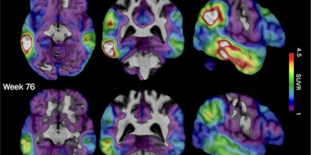 New experimental Alzheimer’s drug shows potential after study shows slower cognitive decline