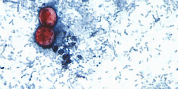 What the Cyclospora Outbreak Reveals