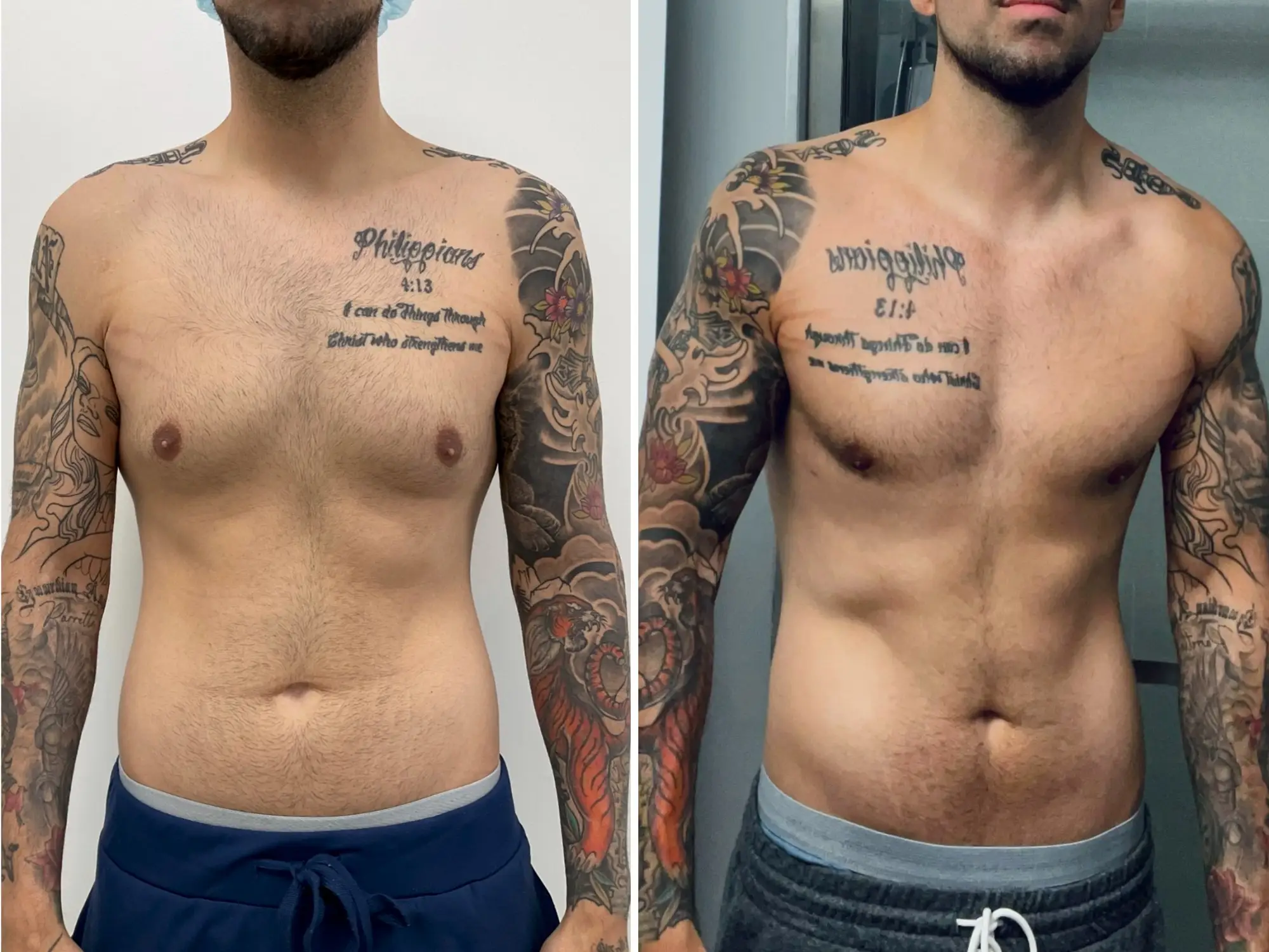 Before and after photos of a man who had liposuction on his chest, a procedure known as gynecomastia.