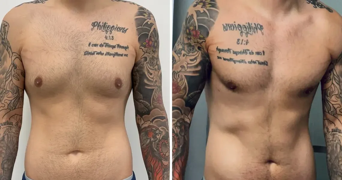 Men get cosmetic surgery, too. I spent $14,000 on plastic surgery, and I don’t regret it.