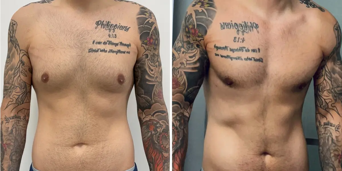 Men get cosmetic surgery, too. I spent $14,000 on plastic surgery, and I don’t regret it.