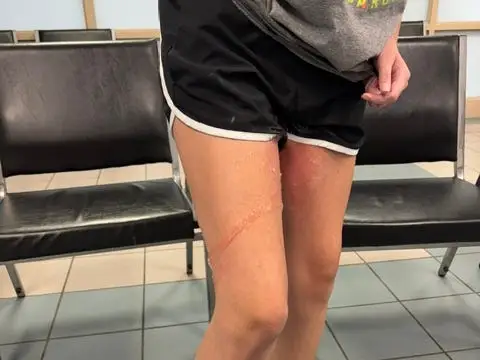 A girl with burns on her legs.