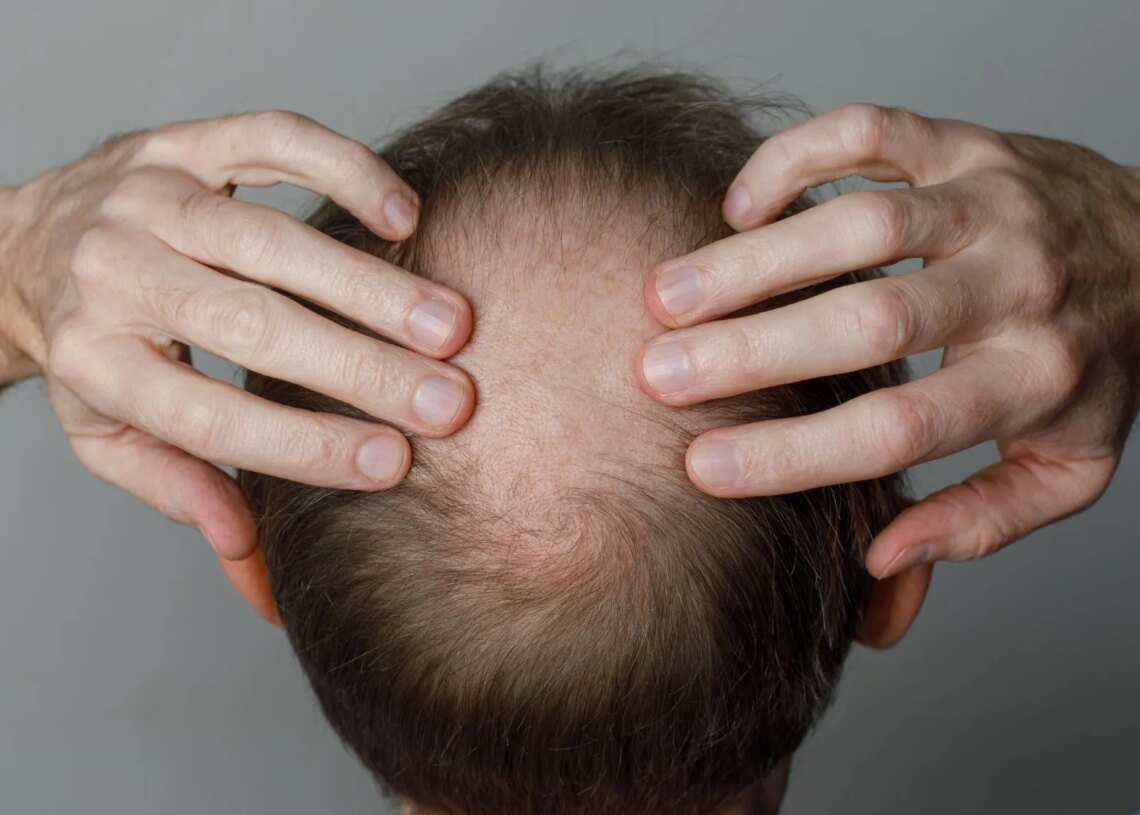 GLP-1 Drugs Like Ozempic May Be Linked to Hair Loss, New Study Finds