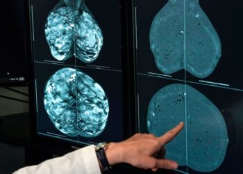 Cancer cases worldwide will soar in the coming decades, a report finds. Here’s why.