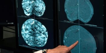 Cancer cases worldwide will soar in the coming decades, a report finds. Here’s why.