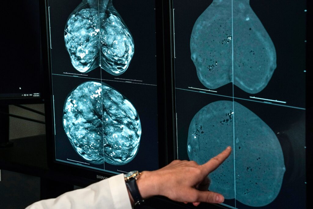Cancer cases worldwide will soar in the coming decades, a report finds. Here’s why.