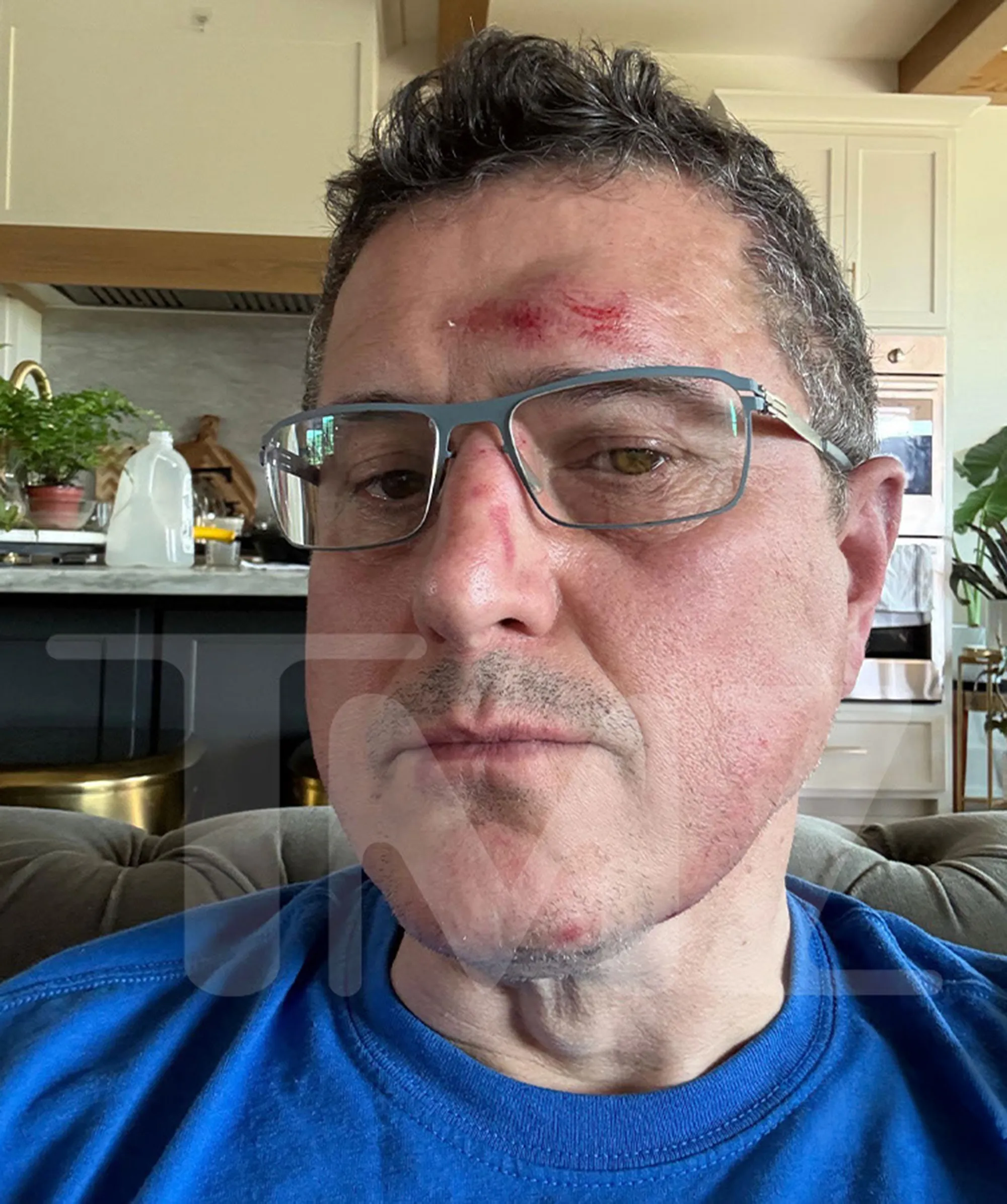 Ronnie Taylor with a bloody injury on his forehead and nose.