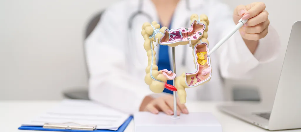 A doctor points to a human colon anatomy model showing colorectal cancer, ulcerative colitis, diverticulitis, and irritable bowel syndrome.