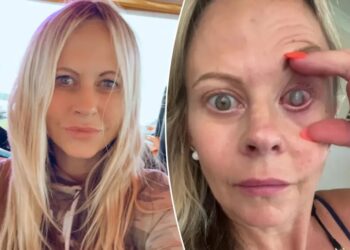 My eye had to be sewn shut after a parasite ate my cornea — the crucial mistake I made