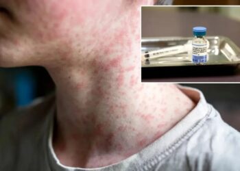 US hits most cases of ‘world’s most contagious disease’ in 35 years — and it’s only July
