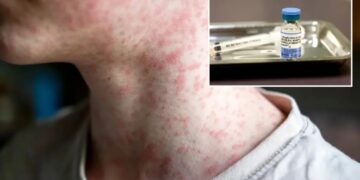 US hits most cases of ‘world’s most contagious disease’ in 35 years — and it’s only July