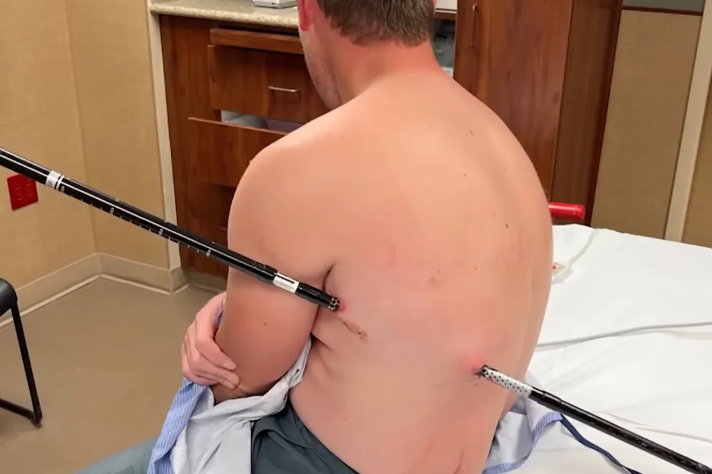 A man with a hiking pole impaled through his back.