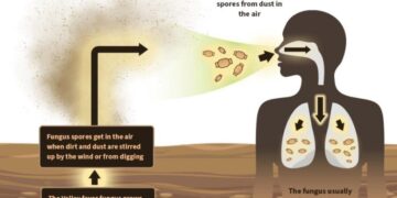 New drug could help people stricken with Valley Fever