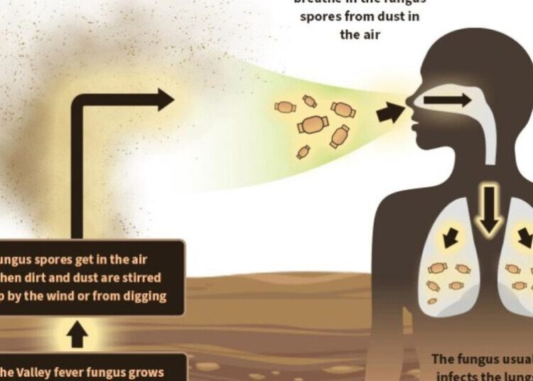 New drug could help people stricken with Valley Fever