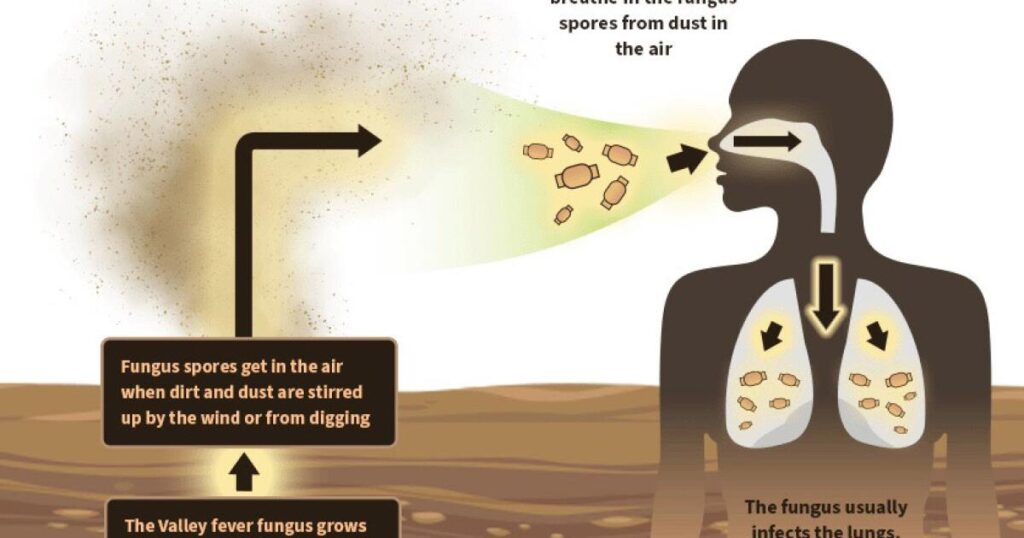 New drug could help people stricken with Valley Fever