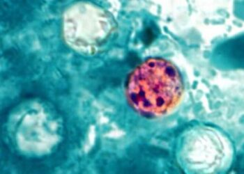 Diarrhea-causing cyclosporiasis exceeds 1,000 cases in U.S. What Californians should know