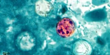 Diarrhea-causing cyclosporiasis exceeds 1,000 cases in U.S. What Californians should know