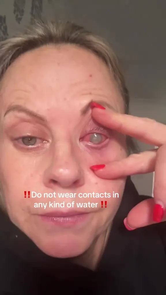 A woman showing her eye with a corneal infection from a parasite.