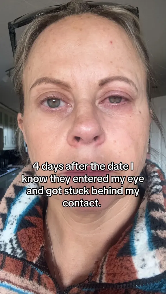 Emma Marsden with an infected eye, four days after a parasite entered her eye while washing her face with contact lenses in.