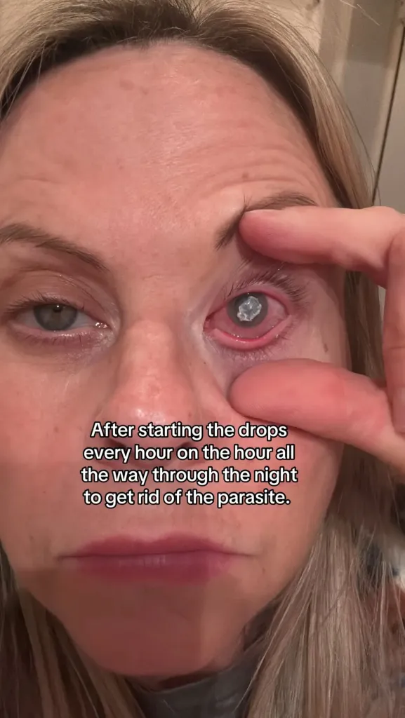 Emma Marsden revealing her eye, infected with a parasite, after washing her face with contact lenses in.