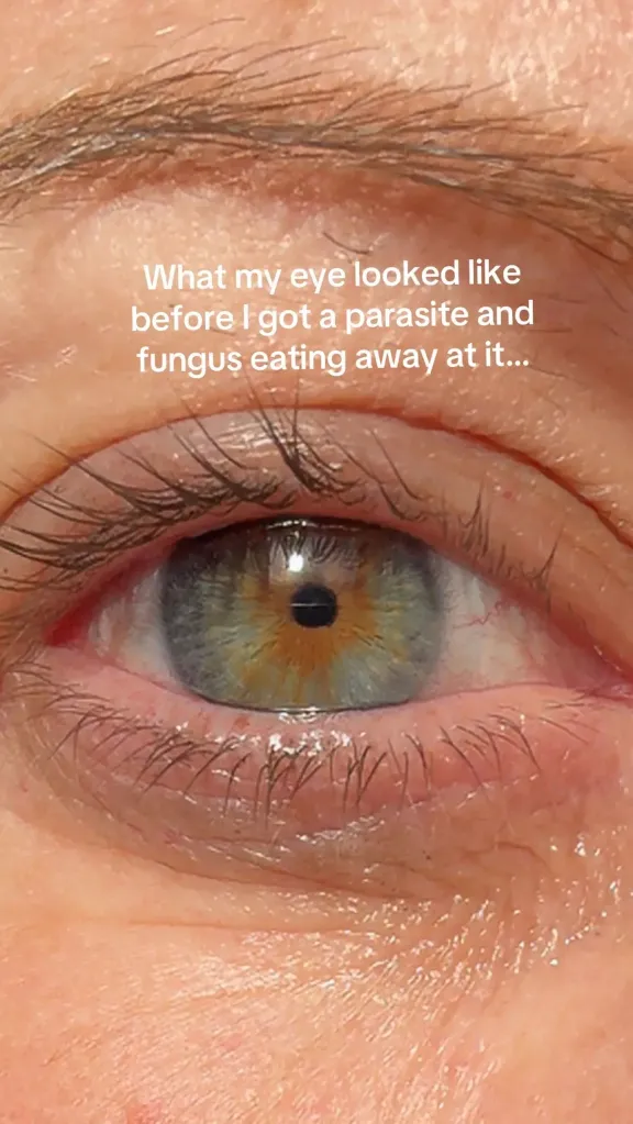 A close-up of an eye with a text overlay about parasite and fungus infection.