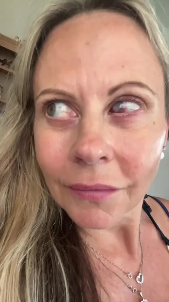 Emma Marsden after getting a parasite in her eye.