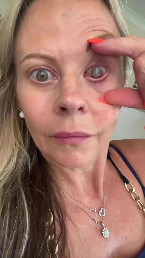 A woman with severe eye irritation holding open her lower eyelid.