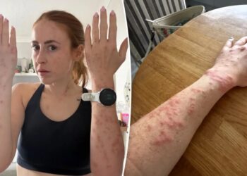 Travel influencer riddled with bleeding bed bug bites after one-night stay at popular international hotel: ‘Wouldn’t wish this on my worst enemy’