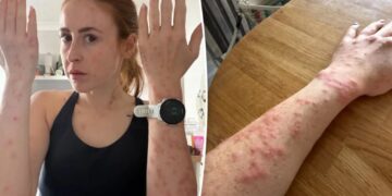 Travel influencer riddled with bleeding bed bug bites after one-night stay at popular international hotel: ‘Wouldn’t wish this on my worst enemy’
