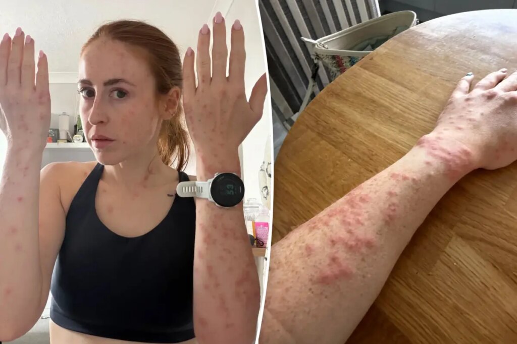 Travel influencer riddled with bleeding bed bug bites after one-night stay at popular international hotel: ‘Wouldn’t wish this on my worst enemy’