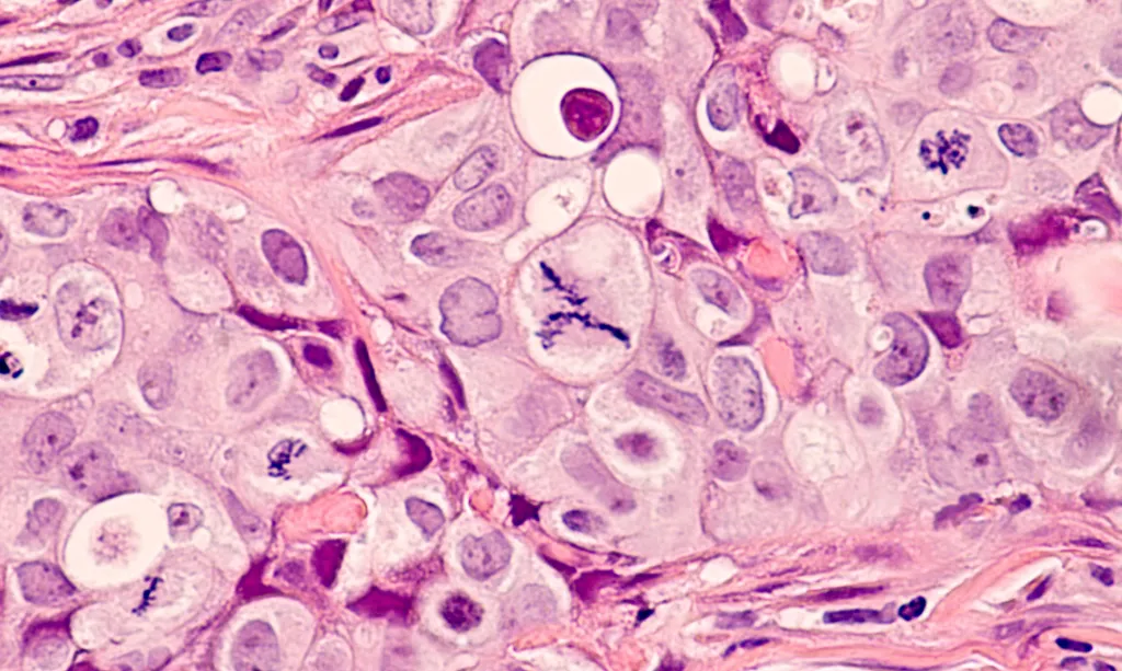 Photomicrograph of grade 3 invasive ductal carcinoma in breast tissue with frequent and atypical mitoses.