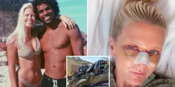 Top surfer and his wife show their horrific injuries after being mangled in California crash
