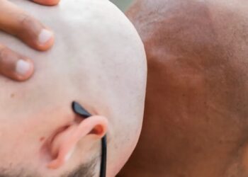 Forget GLP-1 stocks, baldness drugs are Wall Street’s next goldmine