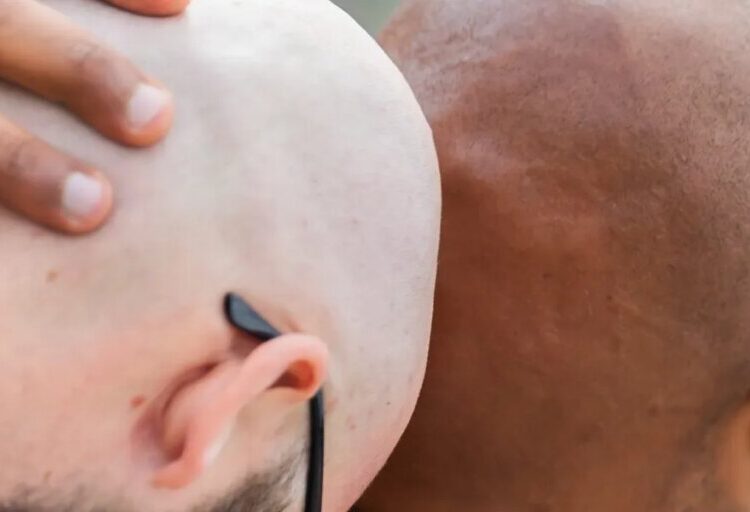 Forget GLP-1 stocks, baldness drugs are Wall Street’s next goldmine