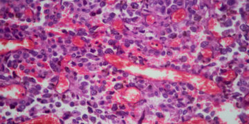 The screenings and other habits doctors recommend as early-onset cancers rise
