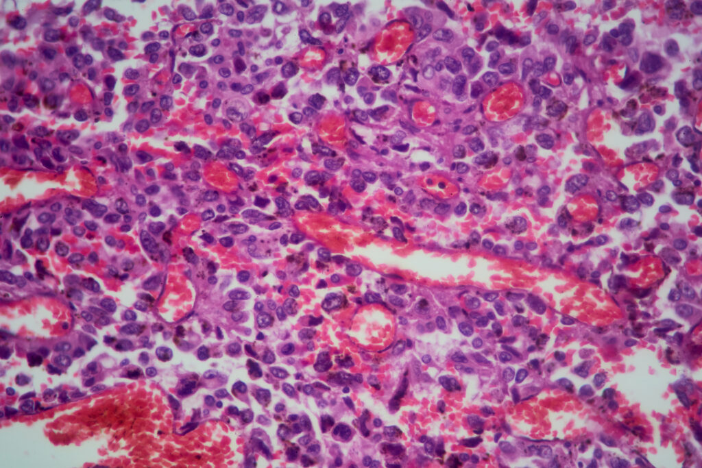 The screenings and other habits doctors recommend as early-onset cancers rise